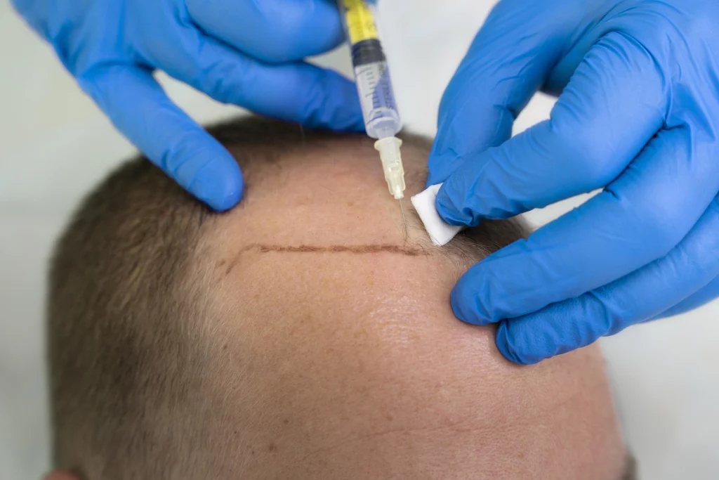 Sapphire Hair Transplant Turkey 1 Sapphire Hair Transplant Turkey