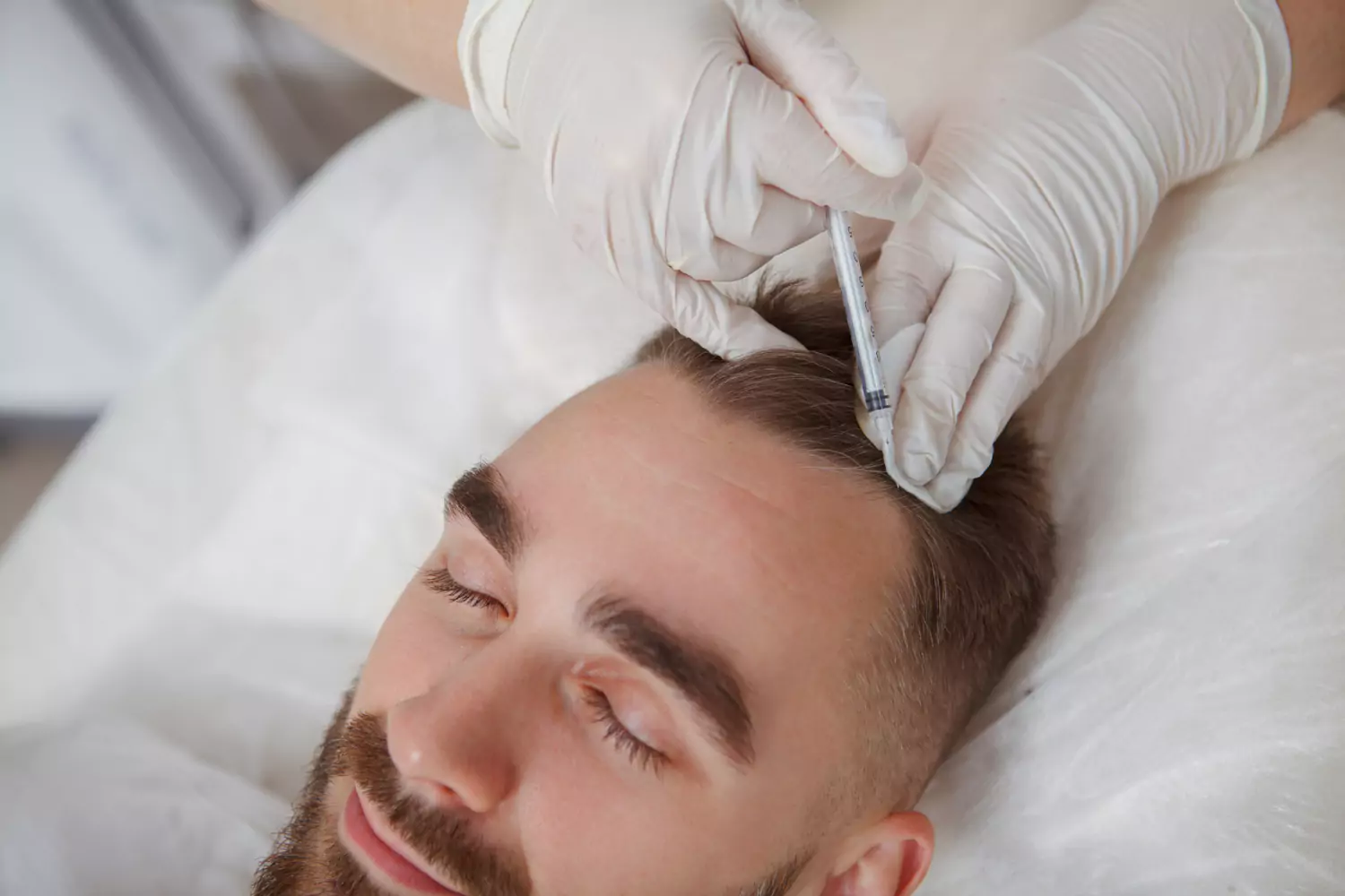 Hårtransplantation