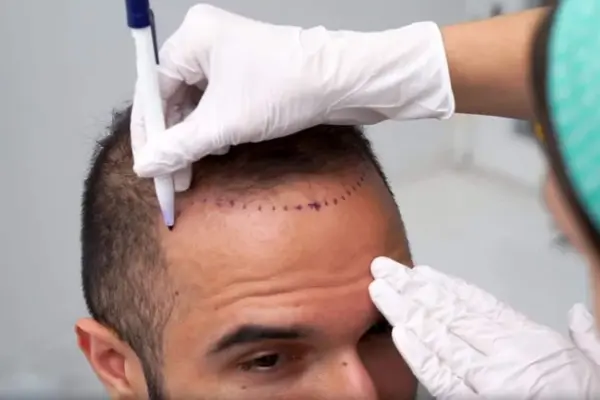 What Is the Best Age for a Hair Transplant? 1 What Is the Best Age for a Hair Transplant?