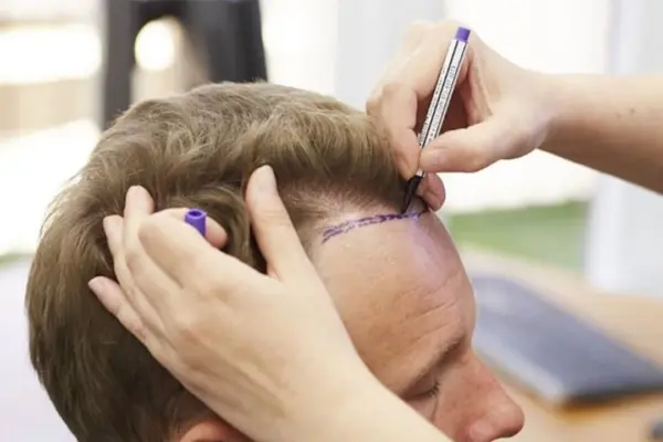 What Happens 20 Years After a Hair Transplant? 3 What Happens 20 Years After a Hair Transplant?